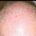 Hair Restoration Before & After Patient #1843