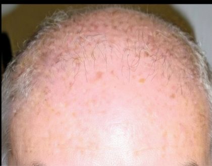 Hair Restoration Before & After Patient #1843