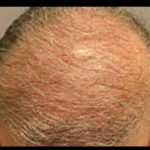 Hair Restoration Before & After Patient #1843