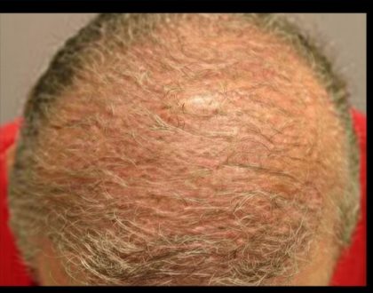 Hair Restoration Before & After Patient #1843