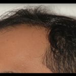 Hair Restoration Before & After Patient #1846