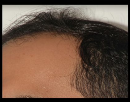 Hair Restoration Before & After Patient #1846