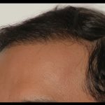 Hair Restoration Before & After Patient #1846