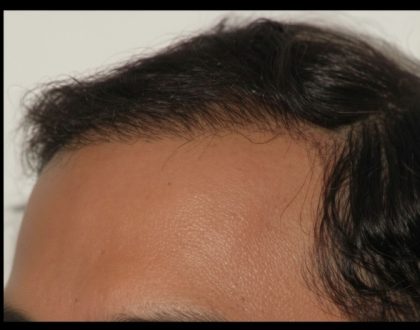 Hair Restoration Before & After Patient #1846
