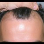 Hair Restoration Before & After Patient #1849