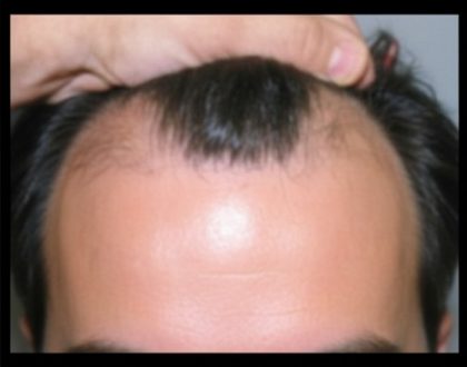 Hair Restoration Before & After Patient #1849