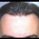 Hair Restoration Before & After Patient #1849