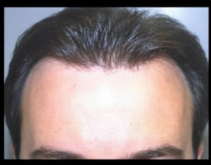 Hair Restoration Before & After Patient #1849