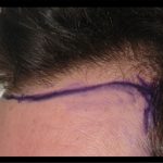 Hair Restoration Before & After Patient #1852