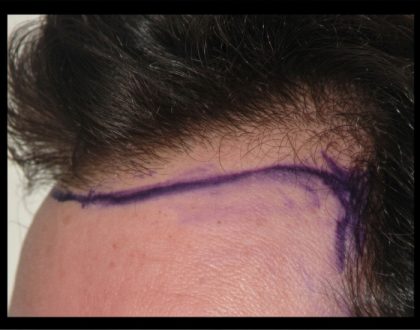 Hair Restoration Before & After Patient #1852