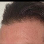 Hair Restoration Before & After Patient #1852