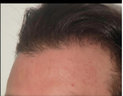 Hair Restoration Before & After Patient #1852
