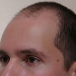 Hair Restoration Before & After Patient #1855