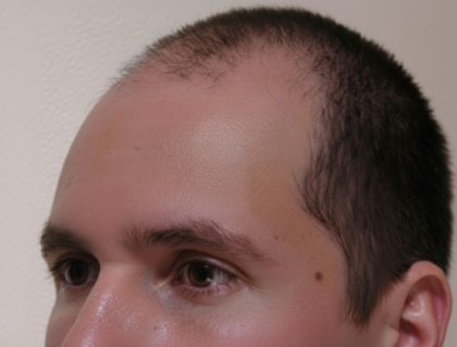 Hair Restoration Before & After Patient #1855