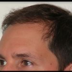 Hair Restoration Before & After Patient #1855