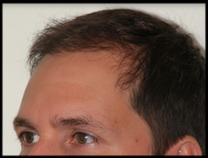 Hair Restoration Before & After Patient #1855
