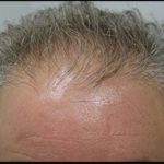 Hair Restoration Before & After Patient #1858
