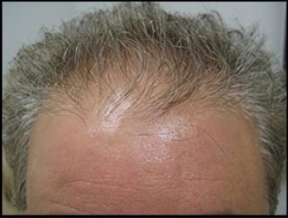 Hair Restoration Before & After Patient #1858
