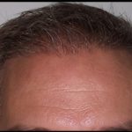 Hair Restoration Before & After Patient #1858