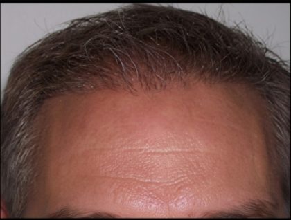 Hair Restoration Before & After Patient #1858