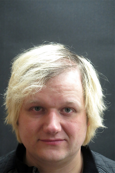 Hair Restoration Before & After Patient #1865