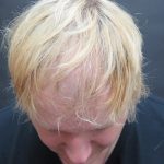 Hair Restoration Before & After Patient #1865