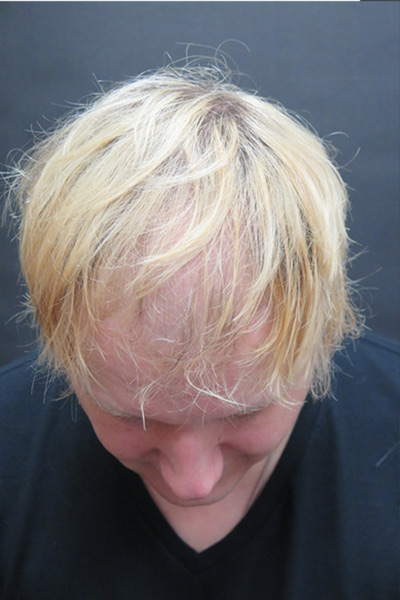 Hair Restoration Before & After Patient #1865