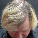 Hair Restoration Before & After Patient #1865