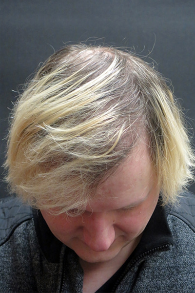 Hair Restoration Before & After Patient #1865