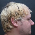 Hair Restoration Before & After Patient #1865