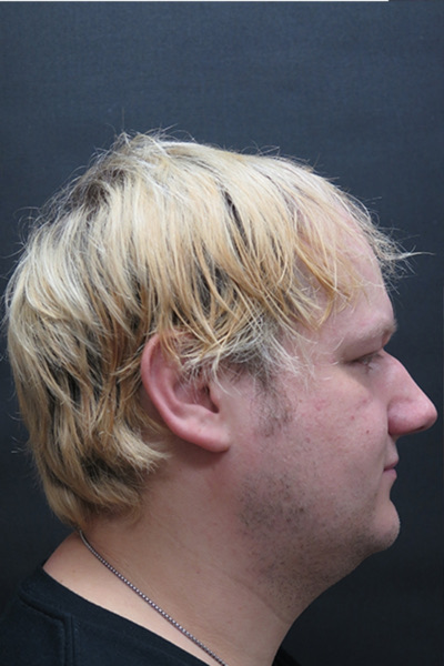Hair Restoration Before & After Patient #1865