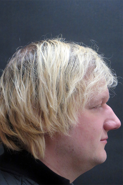 Hair Restoration Before & After Patient #1865