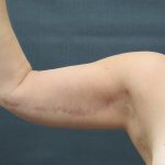 Arm Lift Before & After Patient #888
