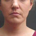 Fat Transfer Before & After Patient #1789