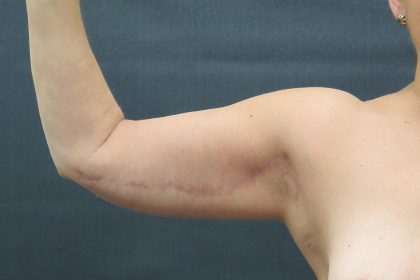 Arm Lift Before & After Patient #888