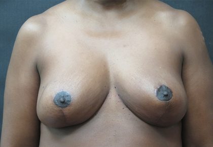 Breast Reduction Before & After Patient #1341