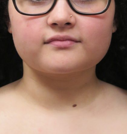 Scarless Facelift and Necklift Before & After Patient #3108