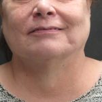 Scarless Facelift and Necklift Before & After Patient #3049