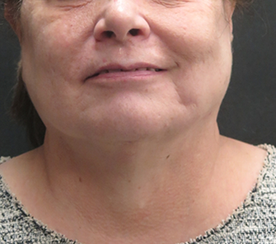Scarless Facelift and Necklift Before & After Patient #3049