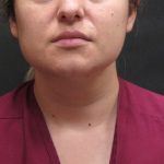 Scarless Facelift and Necklift Before & After Patient #3067