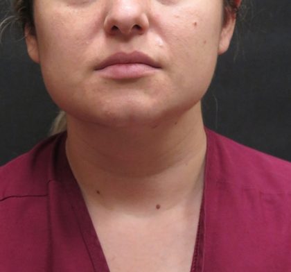Scarless Facelift and Necklift Before & After Patient #3067