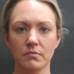 Scarless Facelift and Necklift Before & After Patient #3101