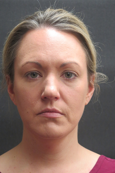 Scarless Facelift and Necklift Before & After Patient #3101