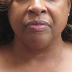 Scarless Facelift and Necklift Before & After Patient #1910
