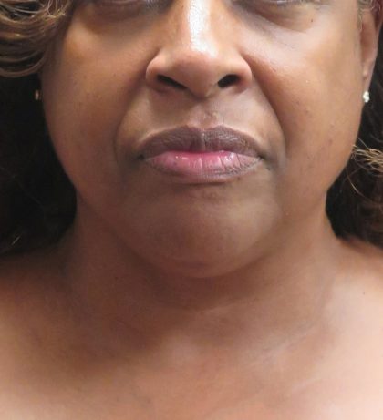 Scarless Facelift and Necklift Before & After Patient #1910