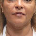 Scarless Facelift and Necklift Before & After Patient #3081