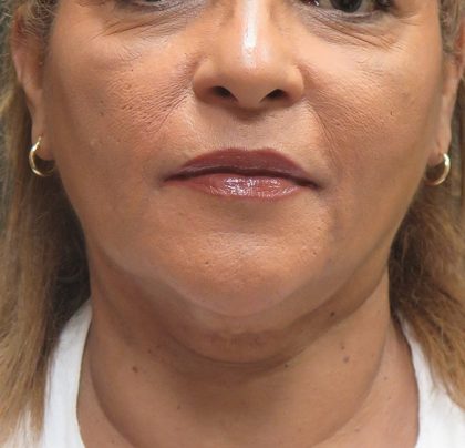 Scarless Facelift and Necklift Before & After Patient #3081