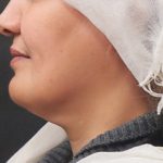 Scarless Facelift and Necklift Before & After Patient #3094