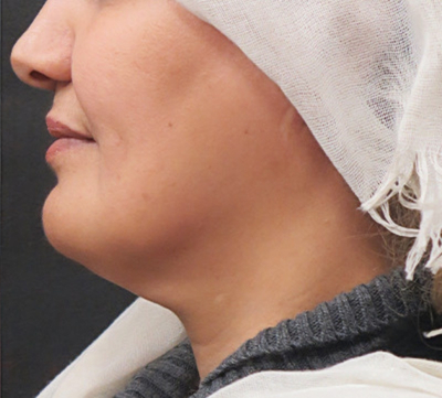 Scarless Facelift and Necklift Before & After Patient #3094