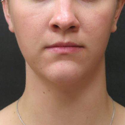 Fat Transfer Before & After Patient #1782
